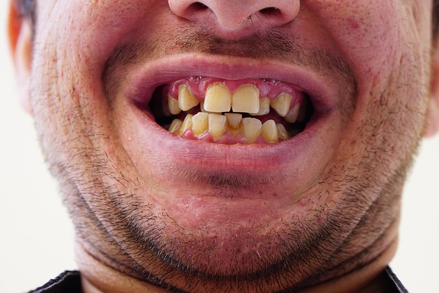 Børn og invisalign: Er det en mulighed?